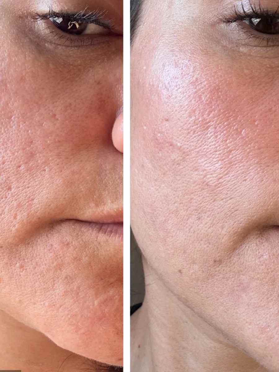Skin needling before and after treatment results for texture improvement