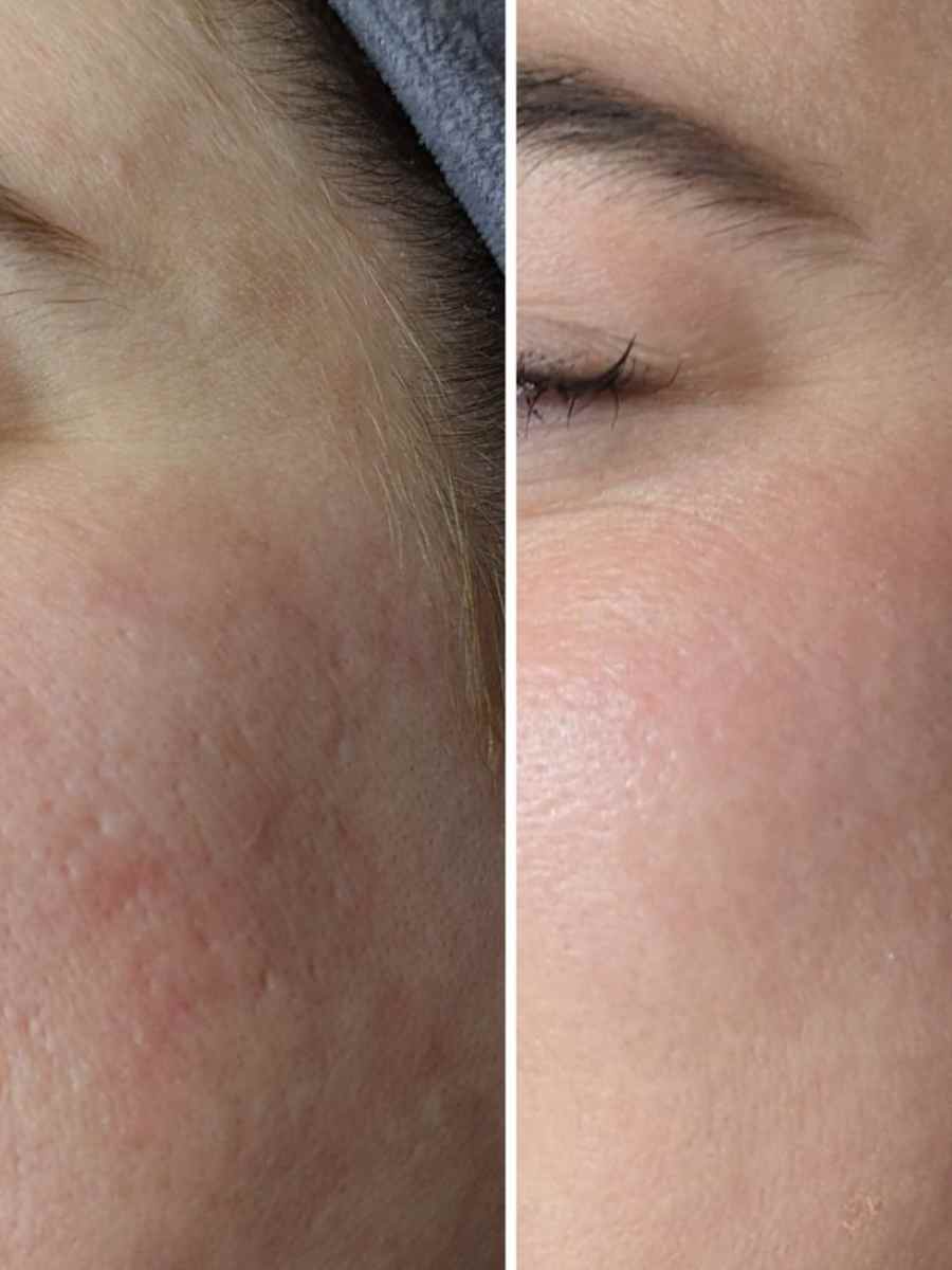 Microneedling before and after skin rejuvenation results