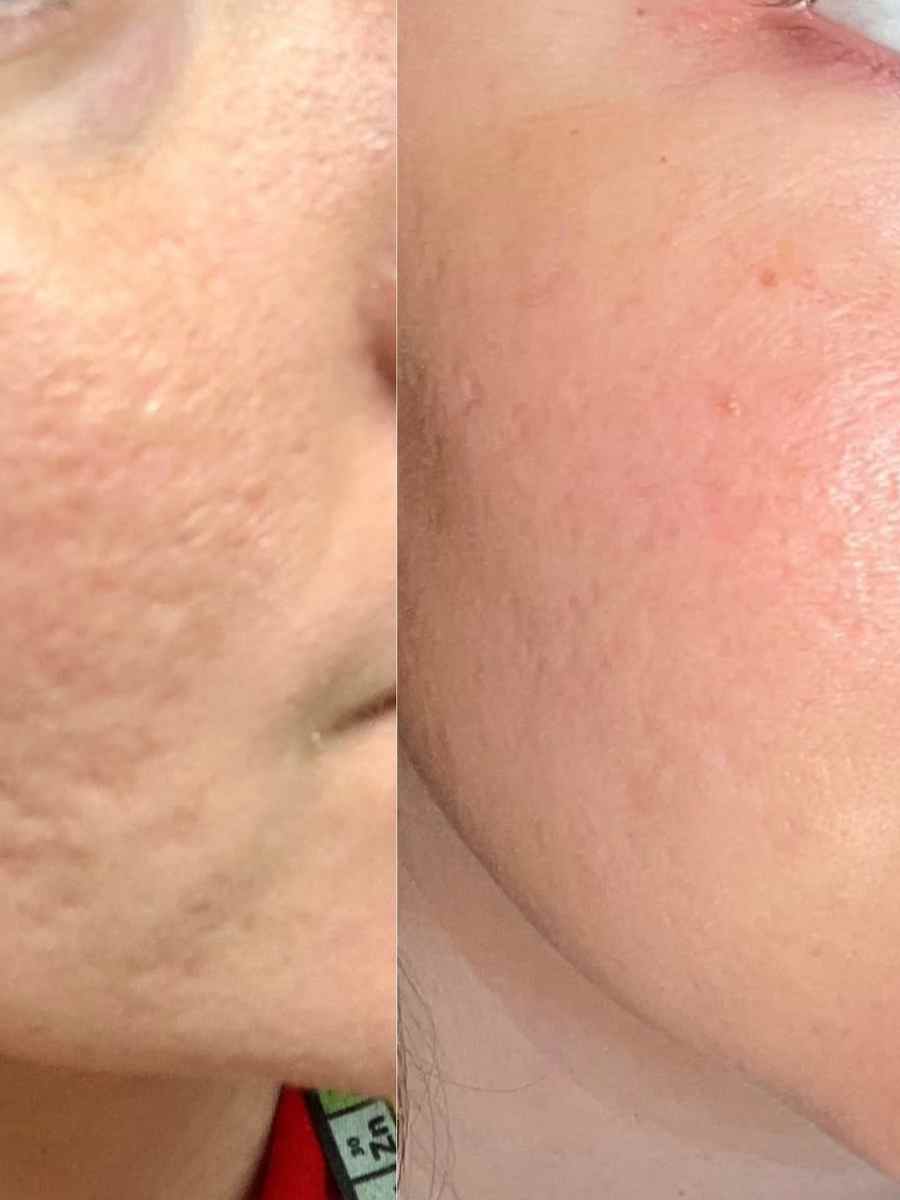 Professional skin needling before and after glow results